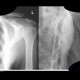 Acromioclavicular joint, separation: X-ray - Plain radiograph
